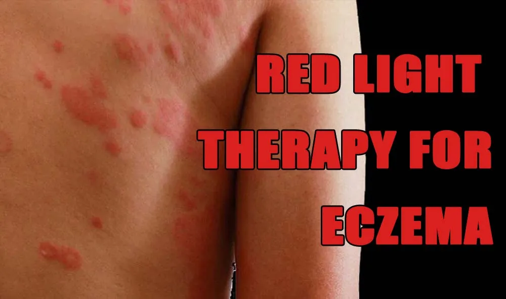 red light therapy for eczema