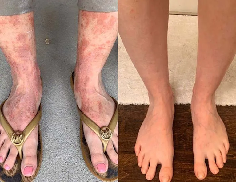 red light therapy before and after