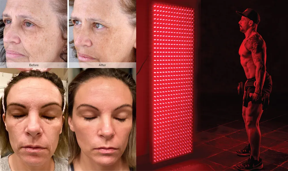 infrared red light therapy before and after