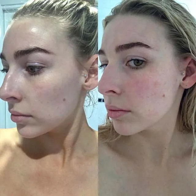 red light therapy hyperpigmentation before and after