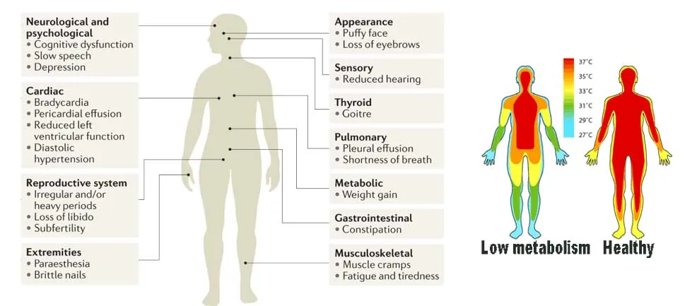 Symptoms of hypothyroidism